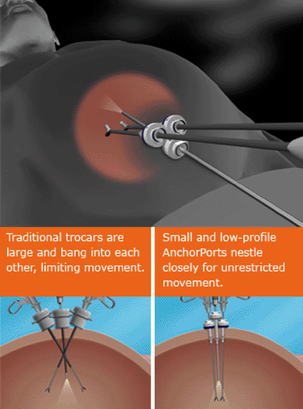 Image: Comparison between the Anchorport SILK and conventional SIL ports (photo courtesy SurgiQuest).